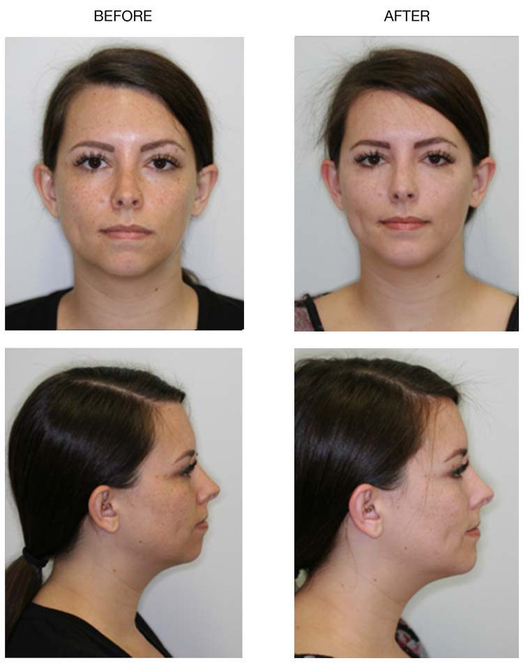 Before and After Photos of Chin Implants Procedure